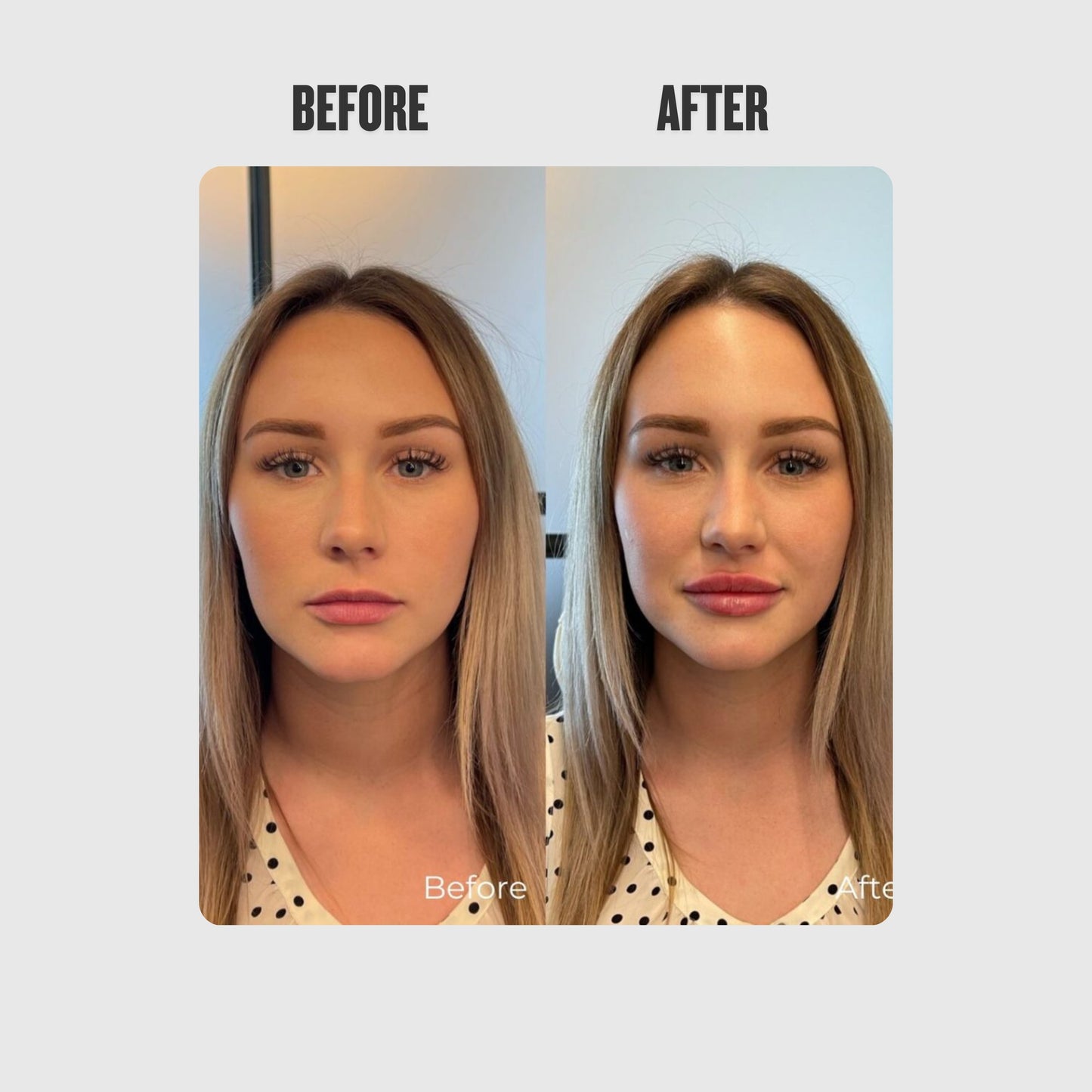 Reedle Shot Lip Plumper™